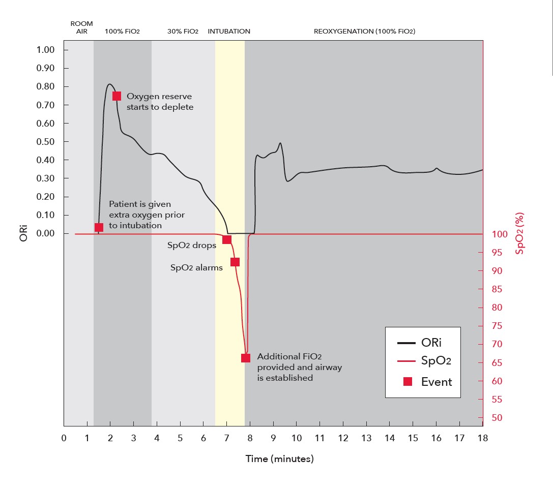 ORi During Orotrachel Intubation Graph